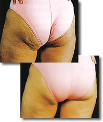 Celulitis